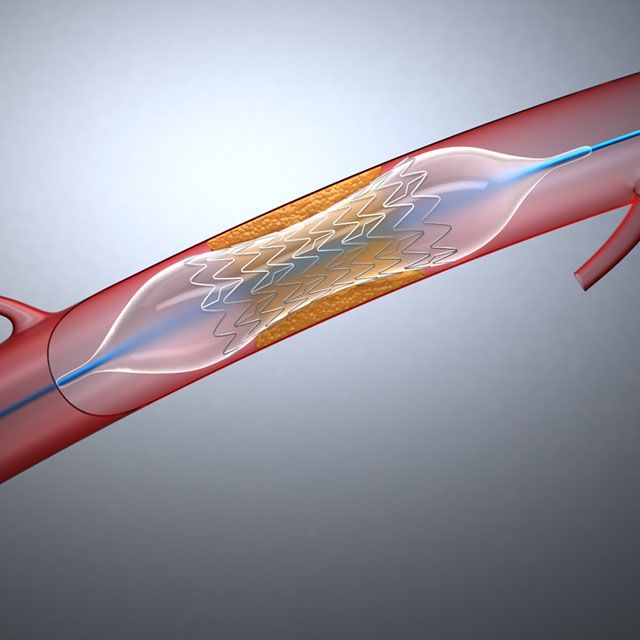 Herzstents (Stent)