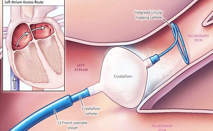 Ablation, Kryoablation