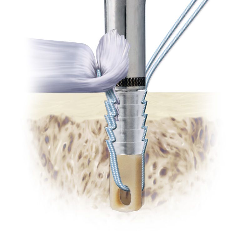  Bio-Force Soft Anchor in chirurgischen Szenarien