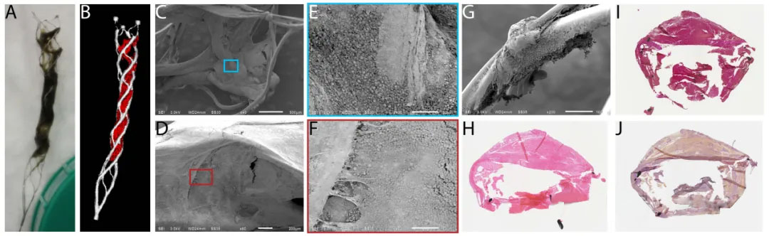 Hochauflösende Bildgebung der Wechselwirkung zwischen Thrombus und Stent-Retriever bei Patienten mit akutem ischämischem Schlaganfall