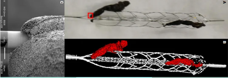 Hochauflösende Bildgebung der Wechselwirkung zwischen Thrombus und Stent-Retriever bei Patienten mit akutem ischämischem Schlaganfall