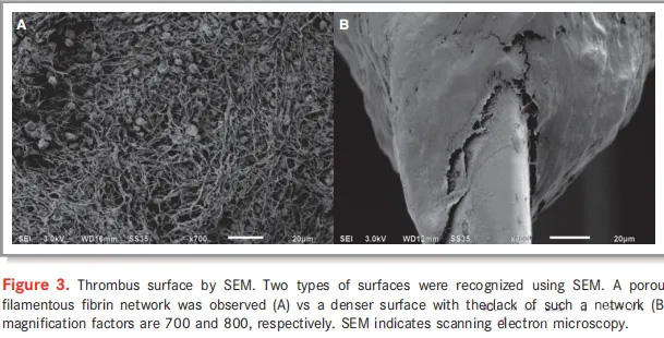 Thrombusoberfläche nach SEM